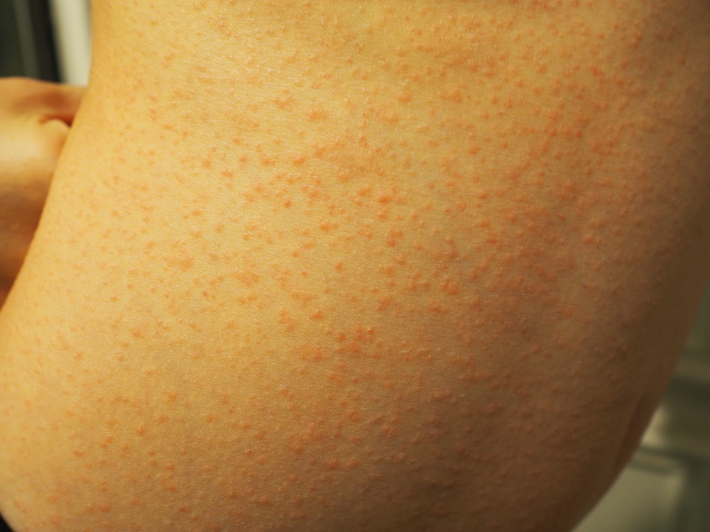 What Is Causing This Pruritic Rash on an Adolescent Boy? Consultant360